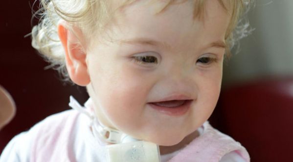 Vidéo : Tessa Evans, la petite fille née sans nez !
