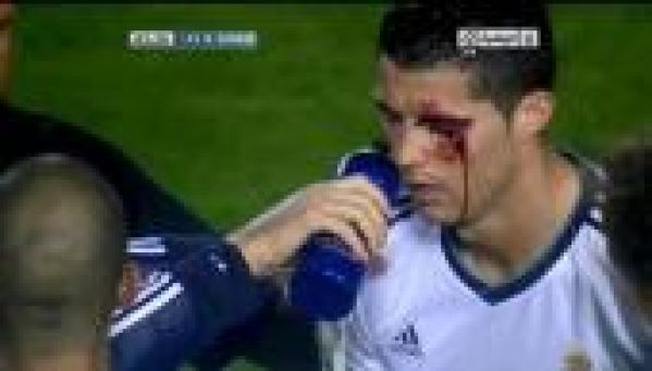 Cristiano Ronaldo en sang après un coup de coude violent !