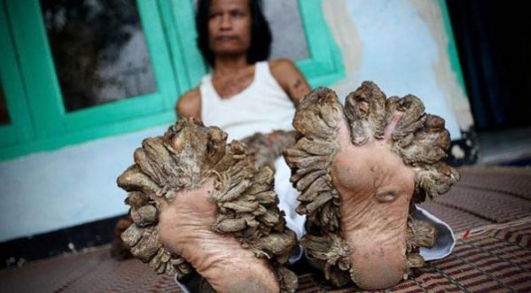 Cet homme se transforme petit à petit en arbre !