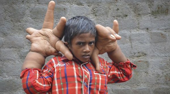Inde : cet enfant possède les plus grandes mains du monde !