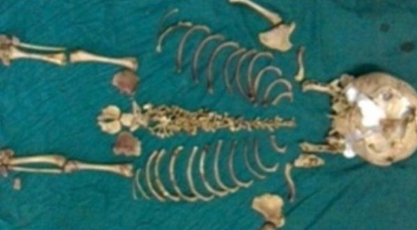 Les médecins trouvent un squelette de bébé laissé à l’intérieur du ventre de sa mère pendant 36 ans !