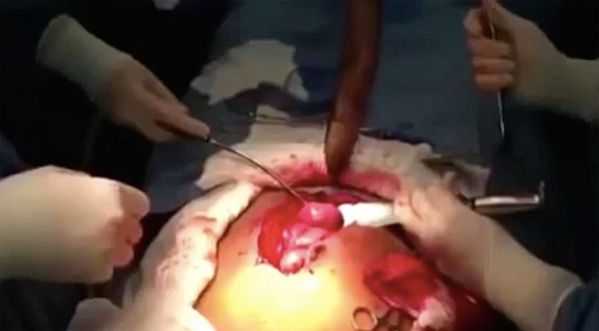 Au Brésil, un homme se fait retirer un poisson vivant de 1,25 m coincé dans ses intestins!!