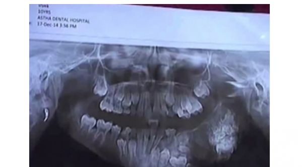 En inde : Un petit garçon avait 80 dents en trop dans la bouche !