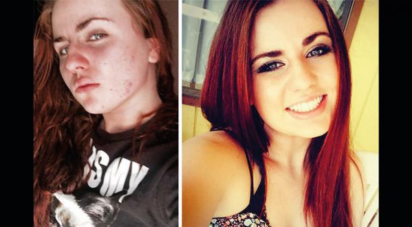 Incroyable: 10 transformations de personnes avant et après avoir arrêté la drogue!