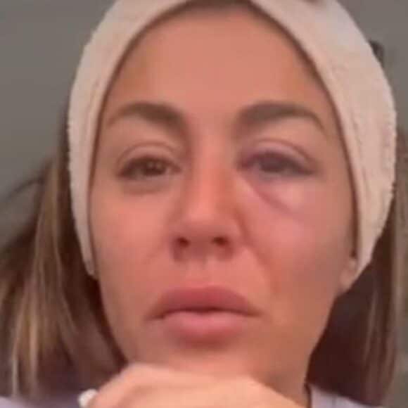 Anais Camizuli défigurée après une terrible agression